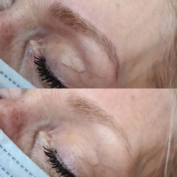 micro needling blond