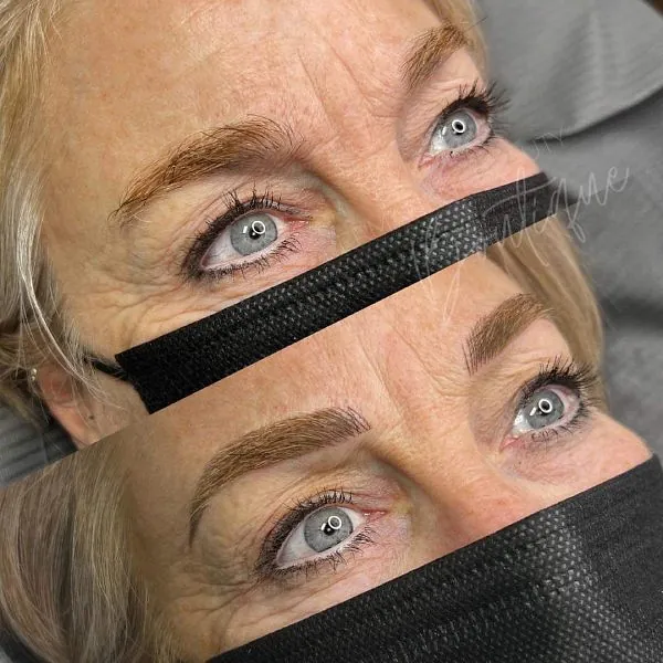 micro needling